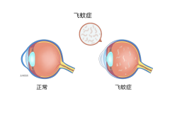 “不起眼”的飞蚊症，可能与这4种原因有关
